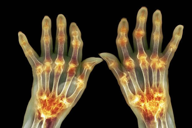 RHEUMATOID ARTHRITIS